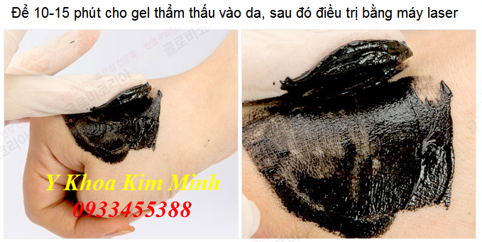 Cách trẻ hóa da mặt bằng gel carbon Cell Line Pro với máy laser yag đầu típ Toning Black Doll - Y khoa Kim Minh 0933455388