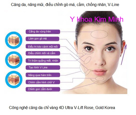 Cong ty cung cap chi cang da 4D Han quoc Ultra V-Lift 25mm 30mm 80mm YKhoa Kim Minh