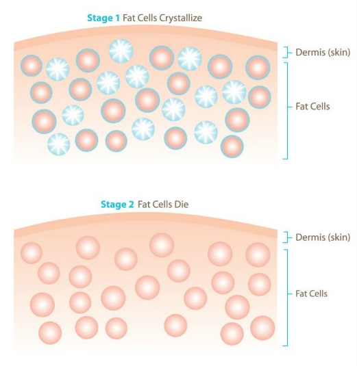 Giảm béo công nghệ quang đông Cryolipolysis