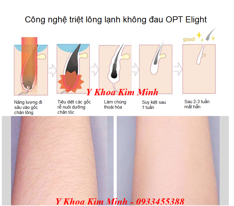 Công nghệ triệt lông lạnh siêu nhanh OPT Elight KM-31 - Y khoa Kim Minh 0933455388