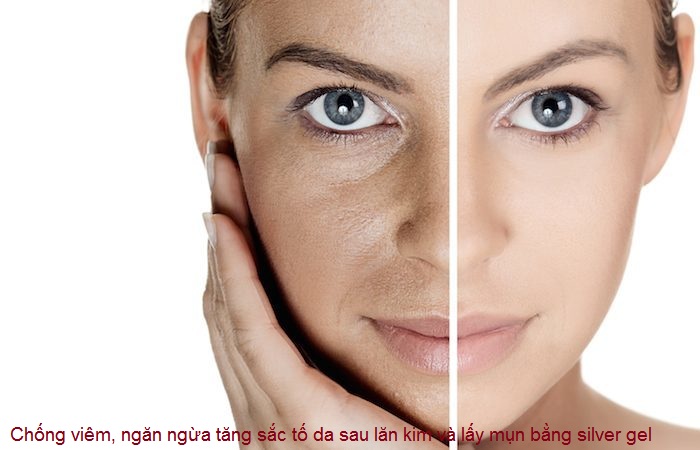 Gel silver ion bac dieu tri tham nam sau lan kim lay mun Y Khoa Kim Minh