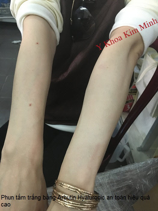 Kem phun trắng AHA Arbutin Hyaluronic Axit Hàn Quốc bán tại địa chỉ Y Khoa Kim Minh
