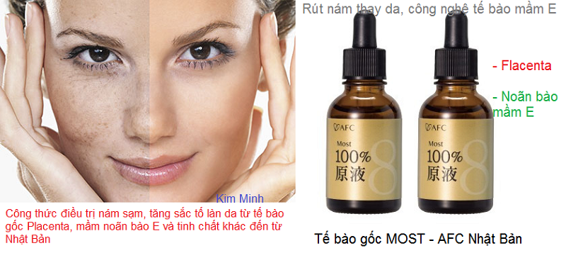 Điều trị nám sạm giúp da sáng trắng bằng tế bào gốc mầm E Most 100% Nhật Bản - Y Khoa Kim Minh Công thức điều trị nám sạm, tăng sắc tố giúp da được tái tạo trắng sáng bằng tế bào gốc mầm E Most 100% nhập khẩu Nhật Bản - Y khoa Kim Minh