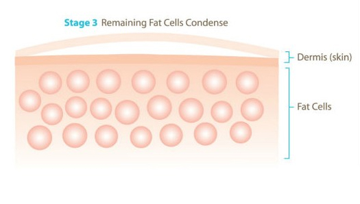 Giảm béo công nghệ quang đông Cryolipolysis