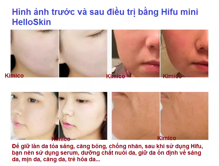 HDSD may hifu mini HelloSkin cang bong chong nhan tre hoa da ban ttai tp hochiminh Y Khoa Kim Minh 0933455388