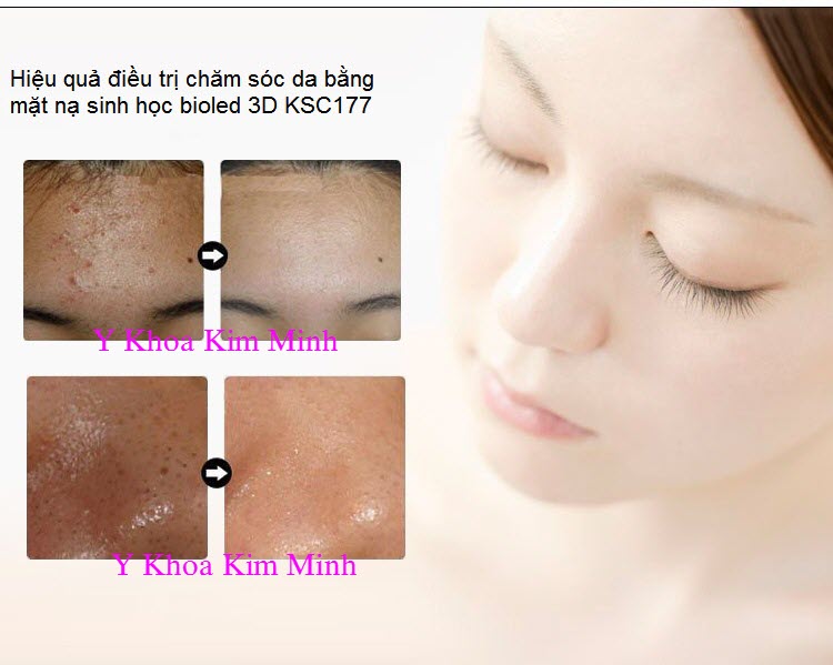 Mat na sinh hoc bioled 3D KSC177 Y khoa Kim Minh