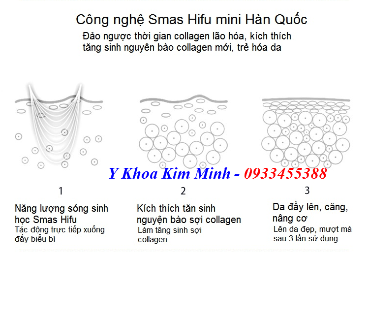 Công nghệ tái tạo trẻ hóa da bằng máy Hifu mini Hàn Quốc Joyjuly - Y Khoa Kim Minh 0933455388