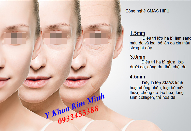 Công nghệ trẻ hóa da nâng cơ bằng máy Hifu SMAS mini Hàn Quốc Joyjuly - Y khoa Kim Minh 0933455388