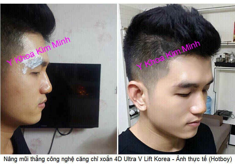 Nang mui bang cong nghe chi vang 4D Ultra V Lift Han Quoc Y Khoa Kim Minh