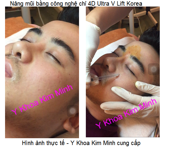 Nâng sóng mũi bằng chỉ 4D Ultra V Lift Rose 50mm Hàn quốc Y Khoa Kim Minh