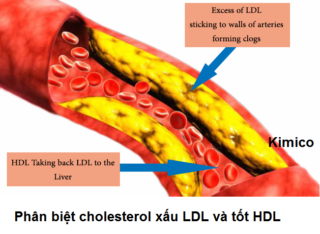 Phan biet cholesterol xau LDL va cholesterol tot HDL Y khoa Kim Minh