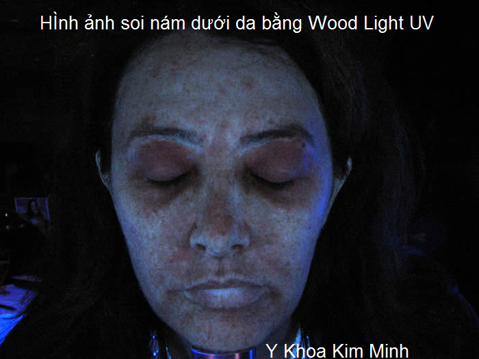 Soi da mat bang den Wood Light UV ke ca nam duoi da 0933455388 Y khoaa Kim Minh