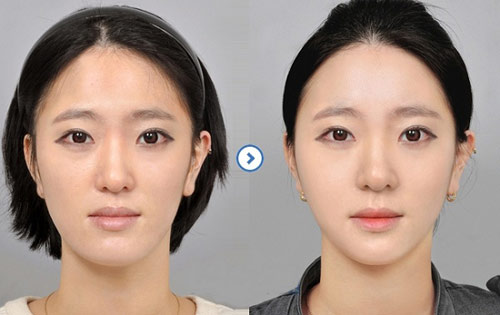 Ảnh: Tái tạo khuôn mặt V line bằng cách tiêm dưỡng chất Ultra Face Hàn quốc Y Khoa Kim Minh