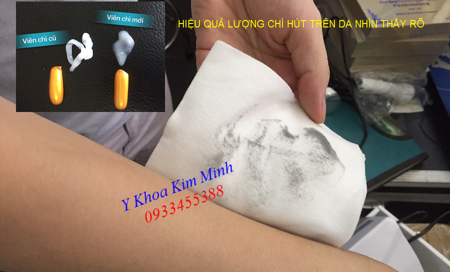 Lượng chì hút lên da nhìn thấy rõ sau khi sử dụng viên hút chì Detox Facial Capsule - Y khoa Kim Minh 0933455388