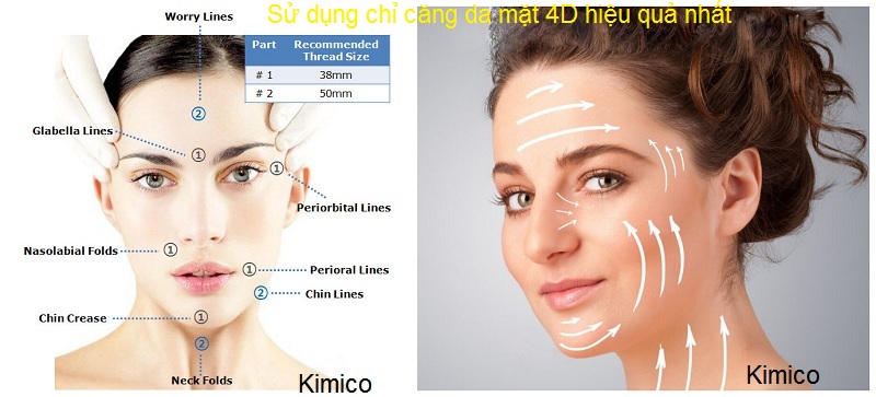 Sử dụng chỉ căng da mặt đúng cho khuôn mặt 4D Ultra V Lift Hàn Quốc Y Khoa Kim Minh