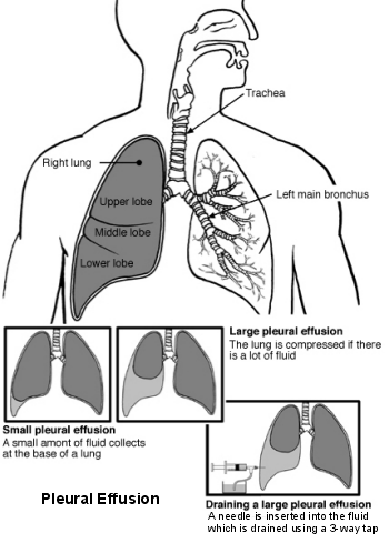 Đặt ống thông rút dịch chữa tràn dịch màng phổi