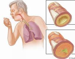 Bệnh viêm phổi hen suyễn và cách điều trị