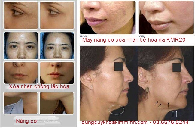 may nang co xoa nhan dieu tri theo ro KMR20