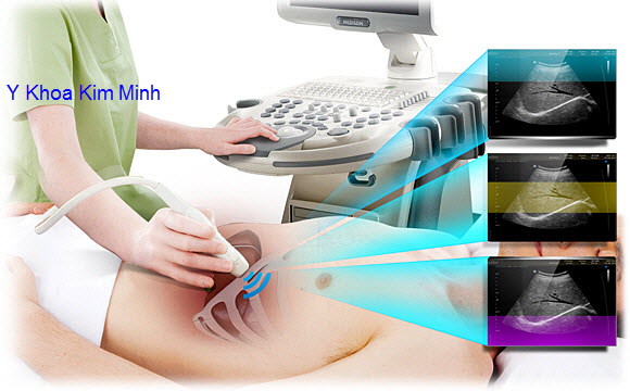 Máy siêu âm màu Samsung Medison X6