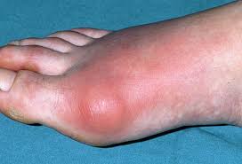 Chữa trị bệnh gout-gút dễ hay khó