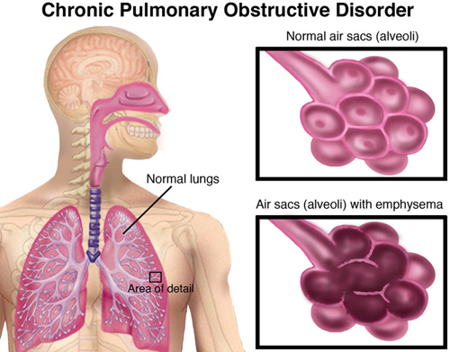 Bệnh phổi tắt nghẽn mãn tính COPD- tác hại của thuốc lá