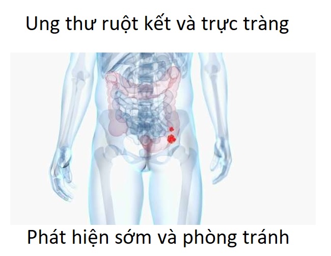 Đây là loại ung thư đứng thứ 2 hiện nay, hãy biết sớm và phòng tránh