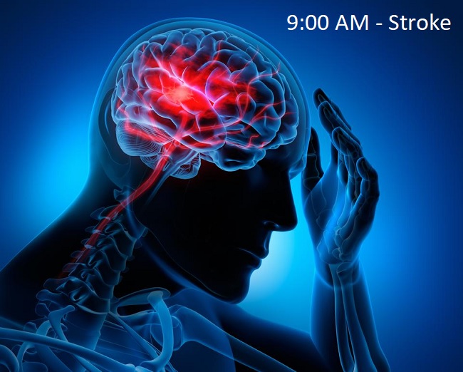 Nhồi máu não gây đột quỵ vào buổi sáng, cảnh giác thực phẩm và cách phát hiện