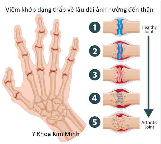 Viêm khớp dạng thấp có thể gây tổn hại cho thận