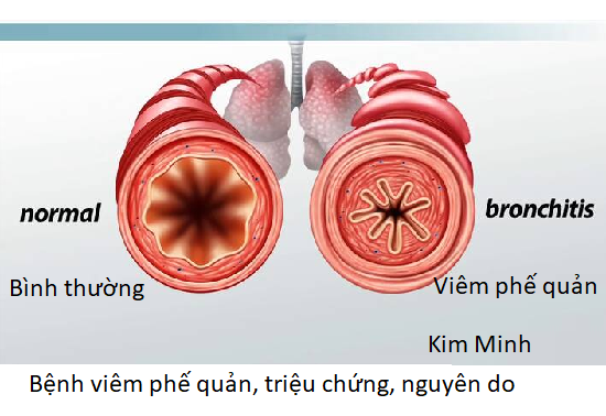 Bệnh viêm phế quản, tìm hiểu rõ hơn