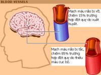 Huyết áp cao và tuổi nào thường xảy ra đột quị