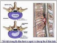 Giường kéo giãn cột sống và phương pháp điều trị hiệu quả Giường kéo giãn cột sống và phương pháp điều trị hiệu quả