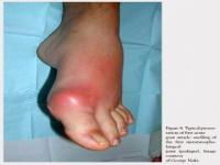 Bài thuốc dân gian chữa bệnh gout -bệnh gút hiệu quả Bài thuốc dân gian chữa bệnh gout -bệnh gút hiệu quả