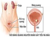 Bệnh tiểu ra máu là gì Bệnh tiểu ra máu là gì