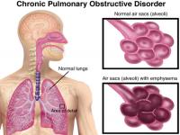 Bệnh phổi tắt nghẽn mãn tính COPD- tác hại của thuốc lá Bệnh phổi tắt nghẽn mãn tính COPD- tác hại của thuốc lá