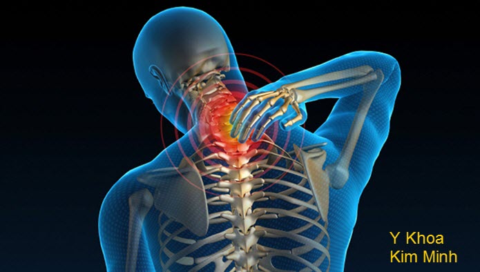 Thoái hóa đốt sống cổ Thoái hóa đốt sống cổ
