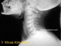 Nguyên nhân và hậu quả của thoái hóa cột sống cổ Nguyên nhân và hậu quả của thoái hóa cột sống cổ
