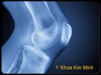 Điều trị và phòng tránh viêm xương khớp Điều trị và phòng tránh viêm xương khớp