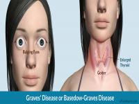 SD thuốc bướu cổ Đông y gia truyền hiệu quả nhất SD thuốc bướu cổ Đông y gia truyền hiệu quả nhất