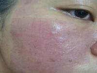 Tìm hiểu về máy CO2 Fractional Laser điều trị da Tìm hiểu về máy CO2 Fractional Laser điều trị da