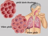Bệnh viêm màng phổi Bệnh viêm màng phổi