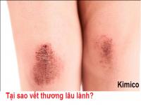 Vết thương lâu lành, tại sao? Vết thương lâu lành, tại sao?