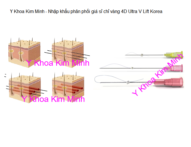 Công ty bán chỉ vàng căng da 4D Ultra V Lift Hàn Quốc