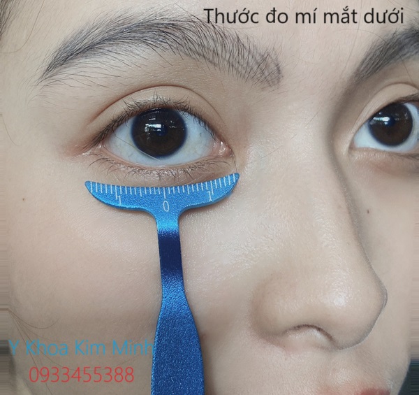 Thước đo mí mắt dưới