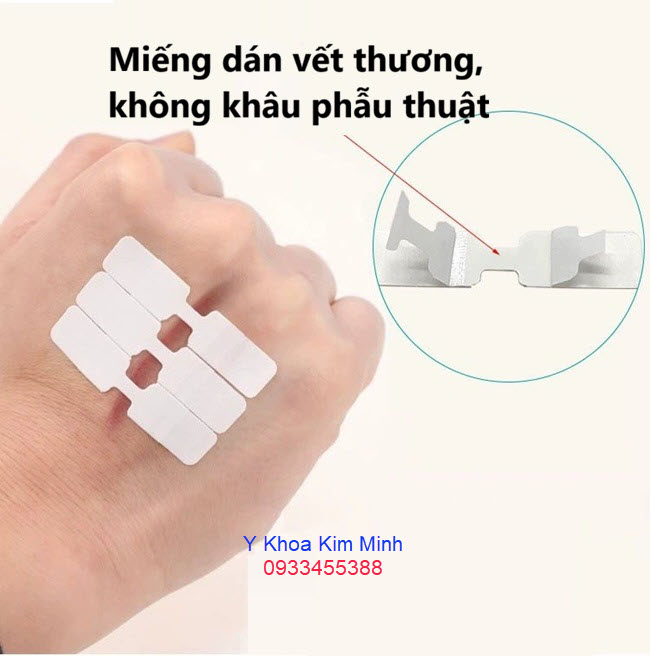 Miếng dán vết thương không khâu phẫu thuật