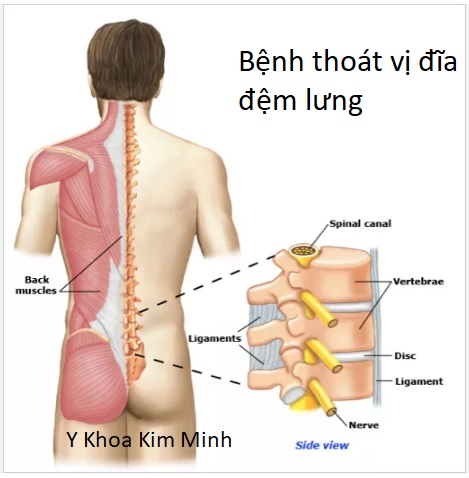 Bệnh thoát vị đĩa đệm lưng, thoái hoá đốt sông và đau lưng