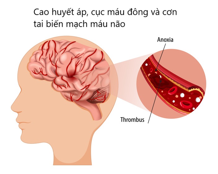 Biểu hiện của cao huyết áp, cục máu đông và nguy cơ xảy ra bệnh tai biến mạch máu não