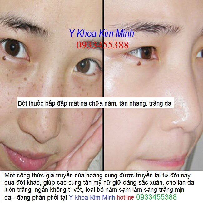 Bột thuốc bắc đắp mặt nạ trị nám tàn nhang, làm sáng trắng da hiệu quả - Y Khoa Kim Minh 0933455388
