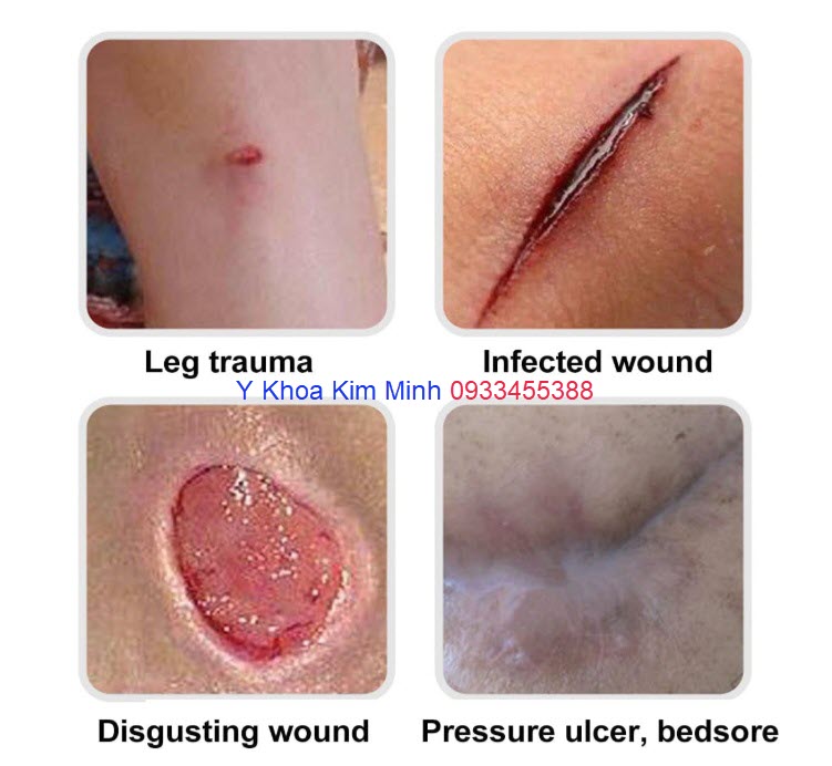 Vết thương hở sử dụng miếng dán y tế hút dịch, gạc hút dịch, miếng dán chăm sóc vết thương có tên là hydrocolloid pads hoặc rolls