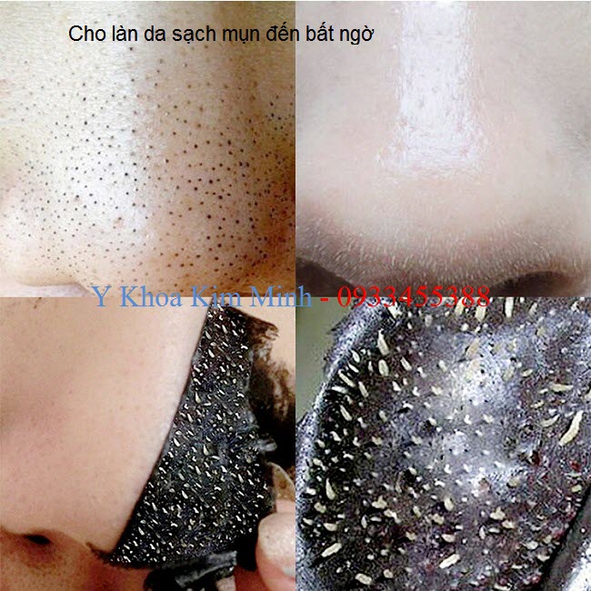Lột sạch da mụn vùng mũi, cho bạn tự tin hơn - Y Khoa Kim Minh Cách điều trị da mụn vùng mũi với miếng dán lột mụn - Y khoa Kim Minh 0933455388