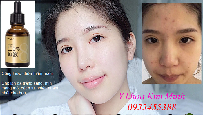 Công thức chữa thâm da mụn, nám sạm bằng tế bào gốc mầm E Most 100 Nhật Bản - Y Khoa Kim Minh Chữa thâm da do mụn để lại bằng tế bào gốc mầm E Most 100% Nhật Bản bán tại Y khoa Kim Minh